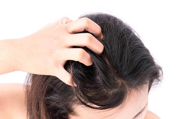10+ cách trị nấm da đầu tại nhà đơn giản- hiệu quả không tái phát