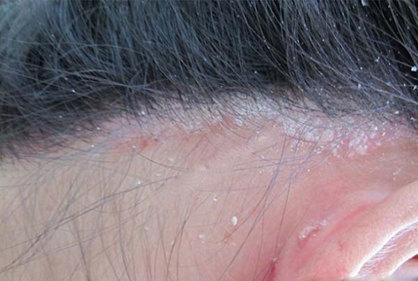 10+ cách trị vảy nến da đầu tại nhà đơn giảm hiệu quả