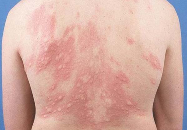 Da nổi mẩn đỏ ngứa khắp người như nốt muỗi đốt là bệnh gì?