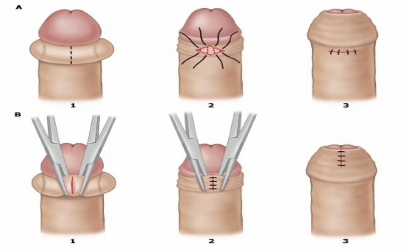 Khi nào cần cắt bao quy đầu